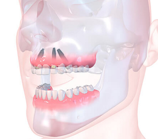 Implant Secured Dentures Affordable Dentures Denture Dental Services United States