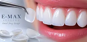 Premium E-MAX veneers for a natural-looking, durable, and aesthetic smile enhancement.