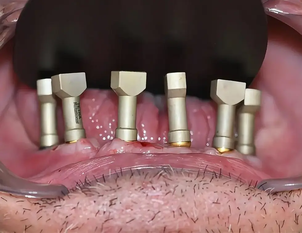 All-on-6 dental implant abutments placed in the jaw