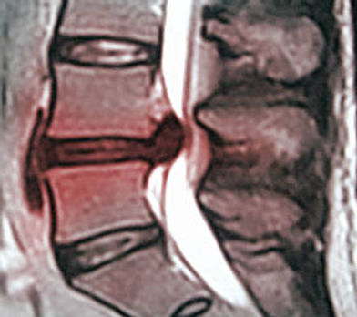 large disc herniation