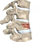 Fraturas-da-coluna-Dr-Felipe-Figueiredo.png