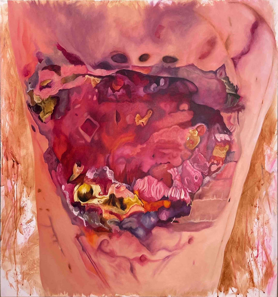 "fifty-six surgical staples-the margins seem clear"
