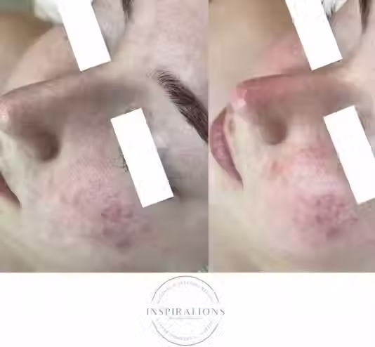 Fire and Ice facial reducing acne and redness before and after results in London Ontario