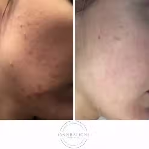 Microneedling reducing acne marks and improving skin clarity before and after in London Ontario