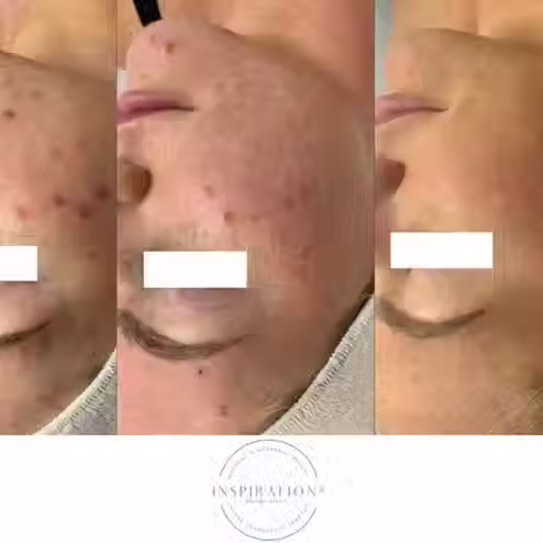 Results from customized treatments and proper medical grade skincare in London Ontario