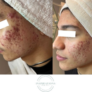 Before and after acne treatment showing refined skin texture and minimized scarring