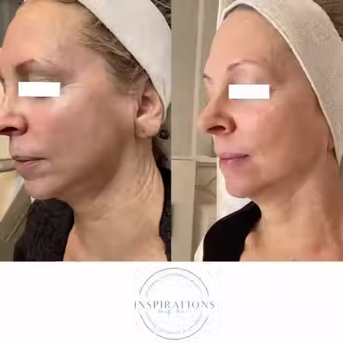 Microneedling treatment improving fine lines, aging skin and hyperpigmentation before and after in London Ontario