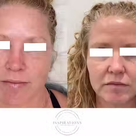 IPL treatment for sun damage before and after showing clearer and brighter skin in London Ontario