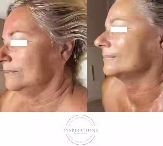 Firming peptide mask improving neck tightening and skin firmness before and after in London Ontario