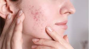 Acne-related redness and inflammation on cheek before treatment in London Ontario