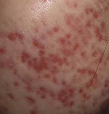 Moderate to severe acne breakouts and inflamed skin before treatment in London Ontario