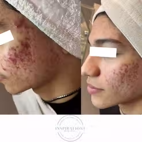 Results from customized treatments focused on post inflammatory erythema and skin texture in London Ontario