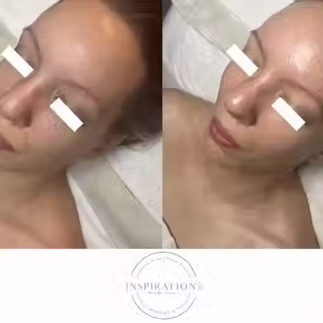 Immediate glow results from Oxygen Facial in London Ontario