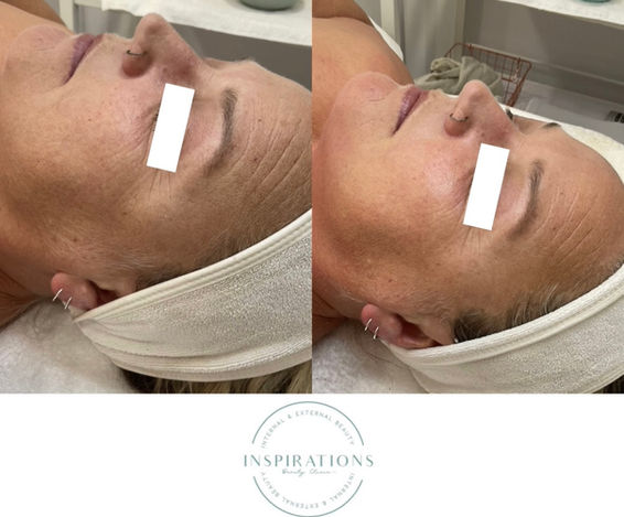 Revitalized dull complexion, increased hydration and reduced fine lines and wrinkles, results from microdermabrasion in London Ontario