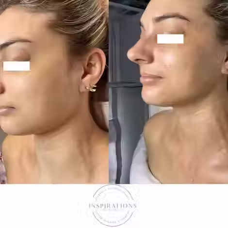 Firming peptide mask results showing improved skin tightening and lift before and after in London Ontario