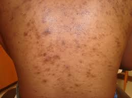 Back acne and post-inflammatory hyperpigmentation before treatment in London Ontario