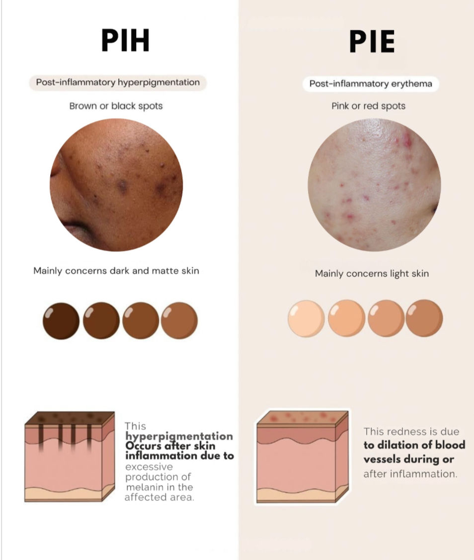 Comparison of PIH and PIE acne marks showing pigmentation versus redness differences