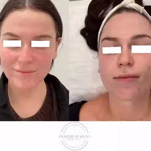 Chemical peel treatment reducing acne scaring, acne inflammation and texture before and after in London Ontario