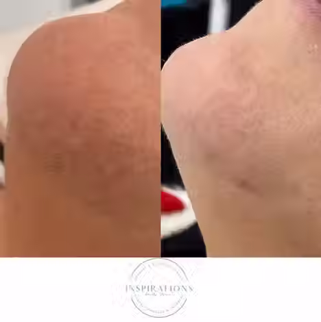 Laser hair removal on chin before and after showing reduced hair growth in London Ontario