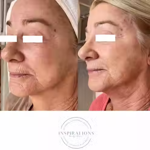 Microneedling skin tightening, reduction in wrinkles and smoother skin complexion results before and after in London Ontario