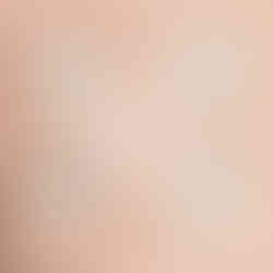 Hydrocolloid acne patch benefits including breathable coverage and blemish protection in London Ontario.