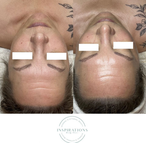 Firming peptide results showing improved skin tightening and lift- specifically around mouth and cheek bones. A significant improvement in fine lines on forehead and overall glow! A great before and after in London Ontario