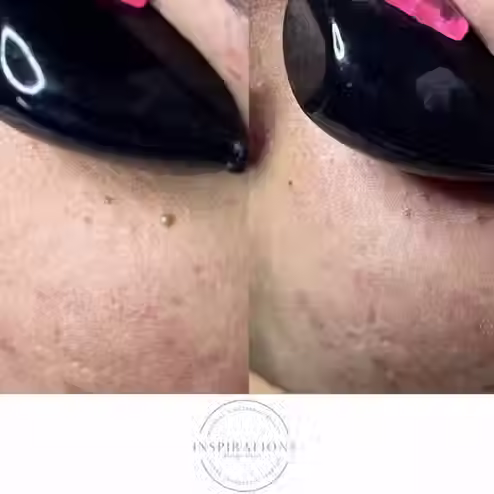 Results from customized treatment and milia removal in London Ontario