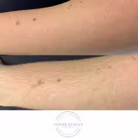 Laser hair removal on arm before and after results with smoother skin in London Ontario