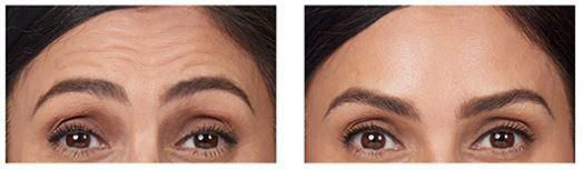 BOTOX for Forehead