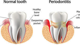 Periodontal Disease