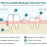 Back Tooth Hurting and Gum Swollen? What It Usually Means and What to Do