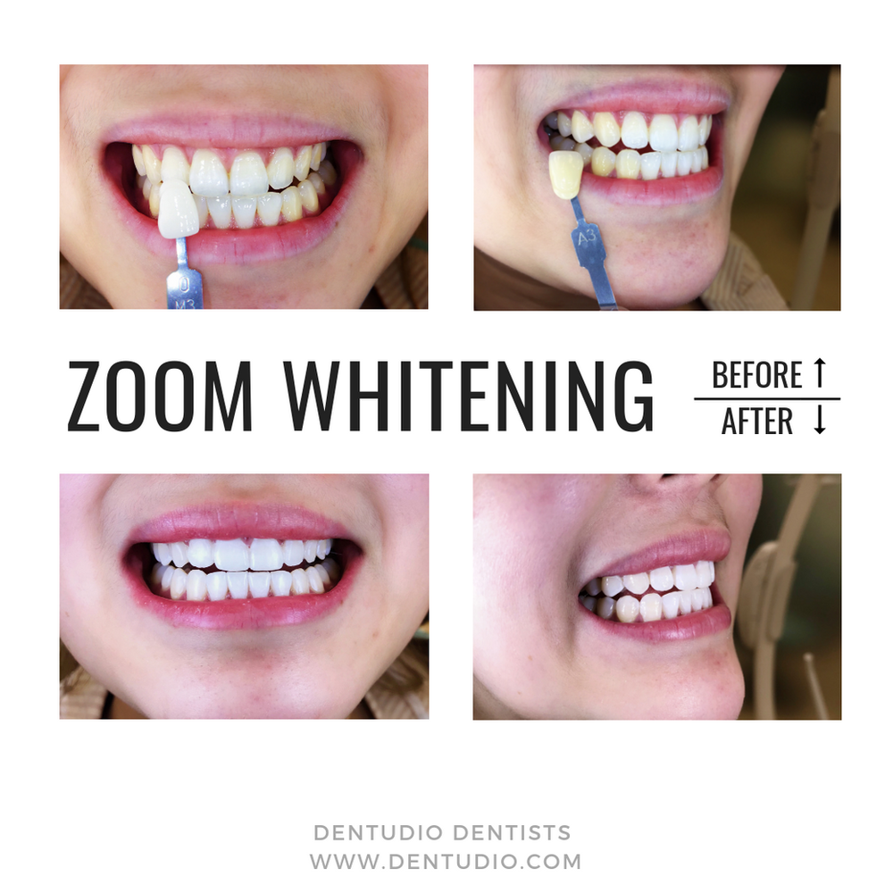 Philips Zoom! Whitening