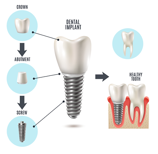 dental implant richmond