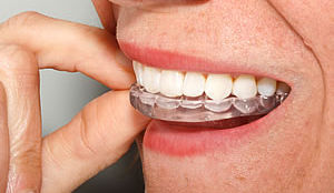 Mouth Guards