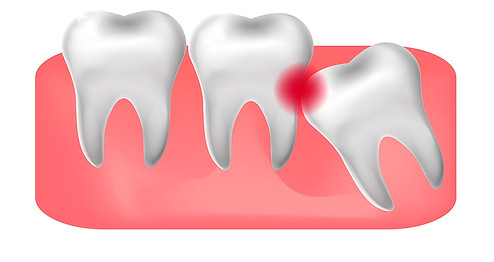 wisdom teeth dentist Richmond