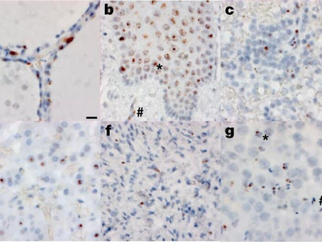 O papel da Autoimunidade na gravidade da C19