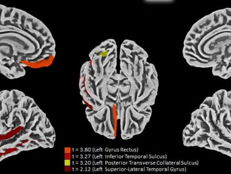 Estudo revela principal alvo do COVID-19 no cérebro e descreve efeitos do vírus no sistema nervoso