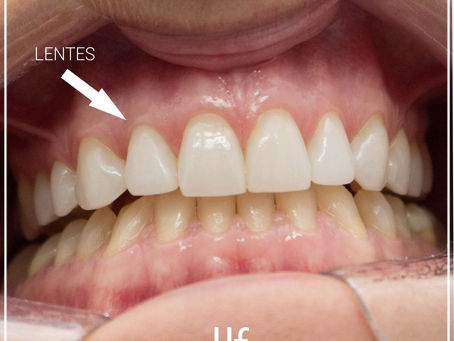 O QUE É LENTE DE CONTATO DENTAL?
