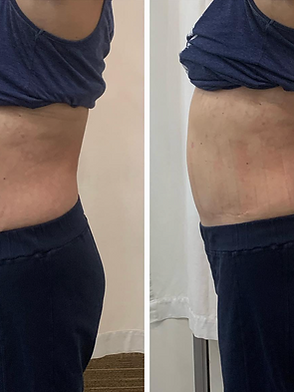 Strawberry Laser Lipo | Oconee Weight and Wellness