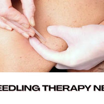 dry needling therapy near me