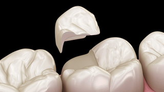 The Best Solution for Chipped or Cracked Teeth
