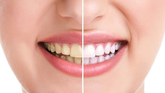 Common Culprits: Foods & Beverages That Cause Teeth Discoloration