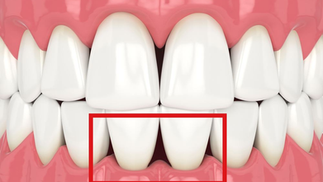Do You Have Black Triangles Between Your Teeth?