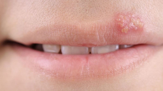 Cold Sores Signs and Treatments