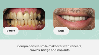 The Combination of Art and Science in Creating Flawless Porcelain Veneers