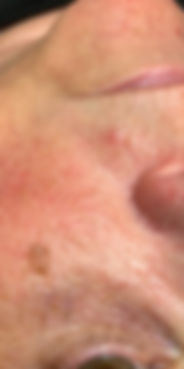 Blemish and mole removal before