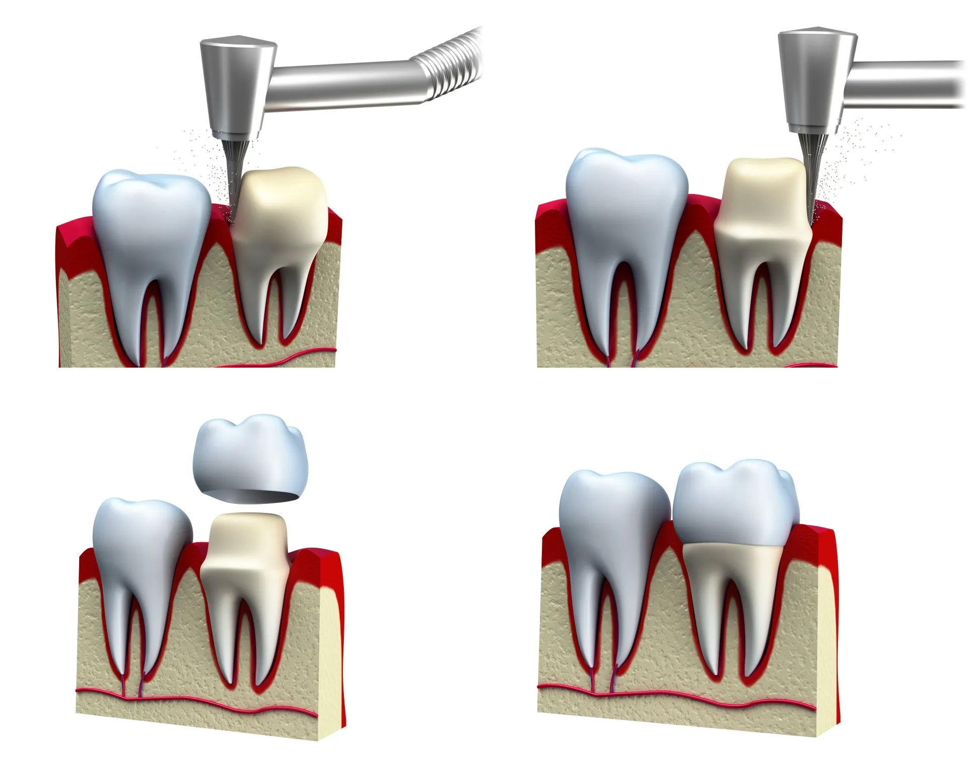 dental procedure for crown