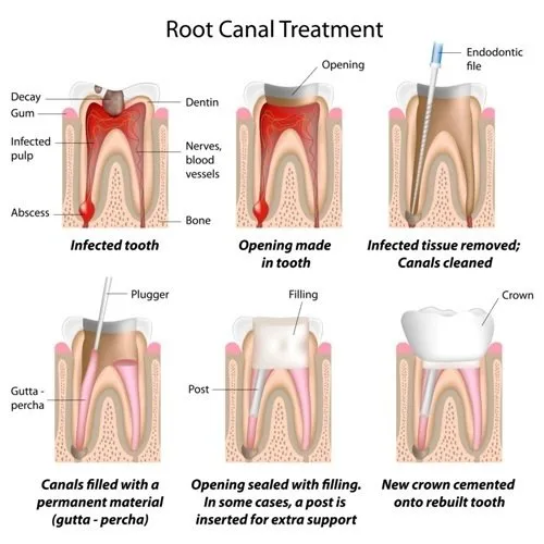Root canal treatment