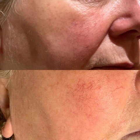 Before and after broken vessel treatment