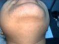 Chin before after years of threading